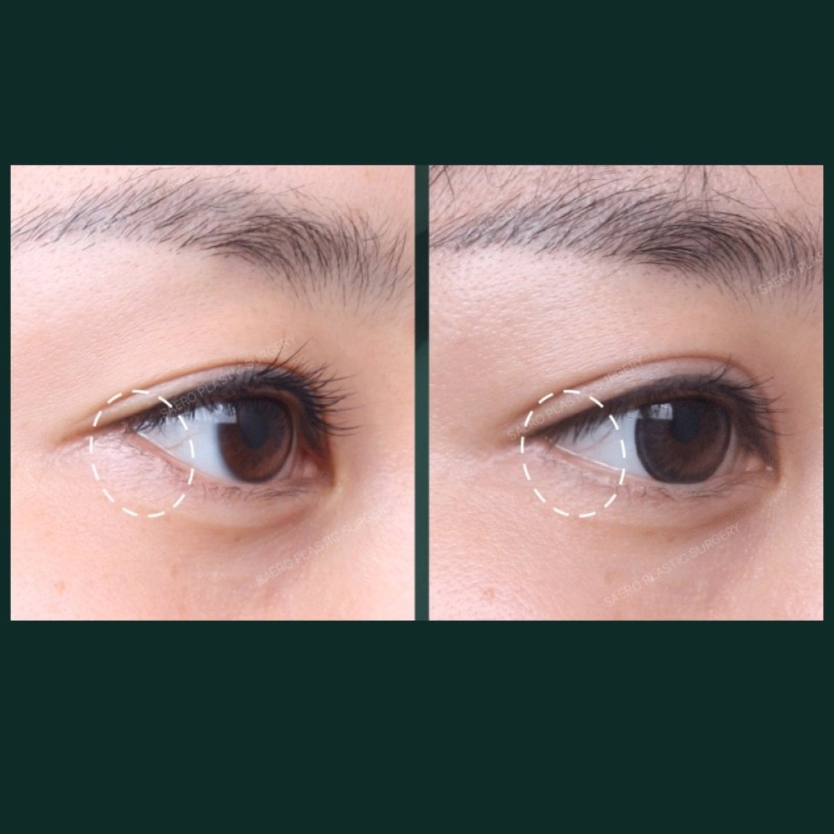 نتائج شد الجفن السفلي قبل وبعد في SAERO Plastic Surgery، تجديد شباب العين