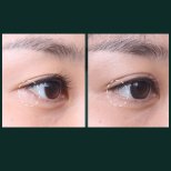 Vorher-nachher-Ergebnis der Unterlid-Blepharoplastik bei SAERO Plastic Surgery, Augenverjüngung