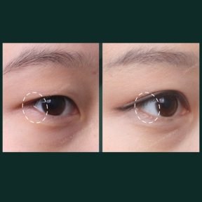 Vorher-nachher-Ergebnisse Unterlid-Blepharoplastik bei SAERO Plastic Surgery, Augenverjüngung