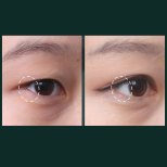 Vorher-nachher-Ergebnisse Unterlid-Blepharoplastik bei SAERO Plastic Surgery, Augenverjüngung
