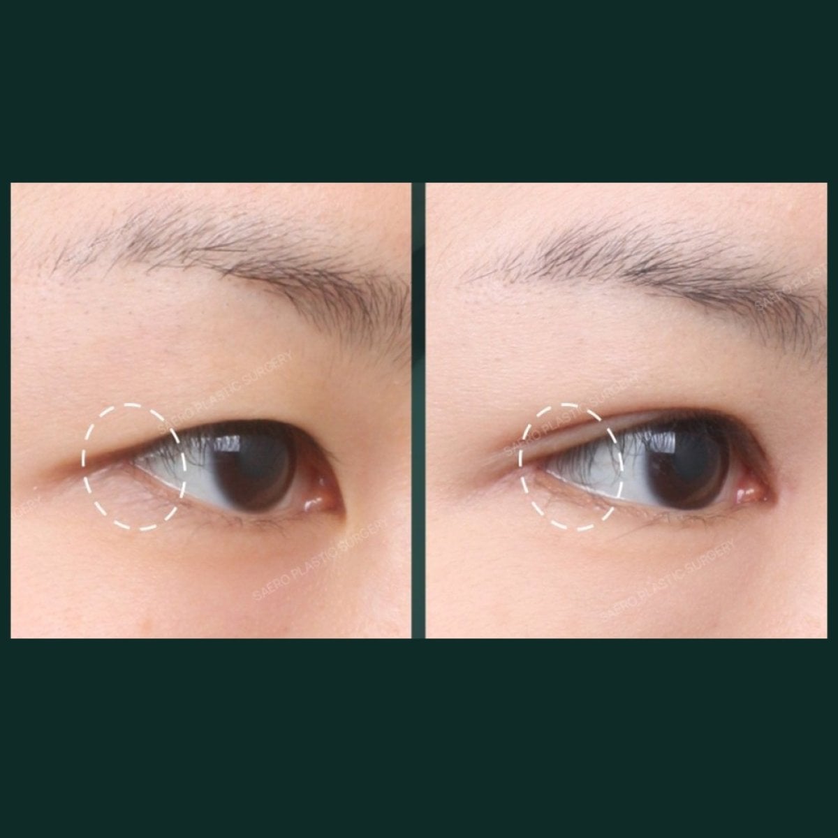 نتائج شد الجفن السفلي قبل وبعد في SAERO Plastic Surgery، تجديد شباب العين