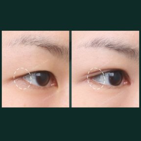 Vorher-nachher-Ergebnisse der Unterlidblepharoplastik bei SAERO Plastic Surgery, Augenverjüngung
