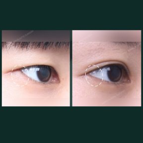 Vorher-nachher-Ergebnisse der Unterlid-Blepharoplastik bei SAERO Plastic Surgery, Augenverjüngung