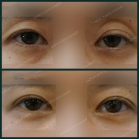 Vorher-nachher-Ergebnisse der Unterlid-Blepharoplastik bei SAERO Plastic Surgery, Augenverjüngung