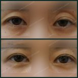 Vorher-nachher-Ergebnisse der Unterlid-Blepharoplastik bei SAERO Plastic Surgery, Augenverjüngung