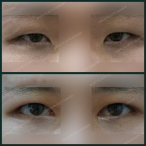 Vorher-nachher-Ergebnis Unterlid-Blepharoplastik bei SAERO Plastic Surgery, Augenverjüngung