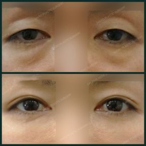 Vorher-nachher-Ergebnis Unterlid-Blepharoplastik bei SAERO Plastic Surgery, Augenverjüngung