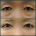 Vorher-nachher-Ergebnis Unterlid-Blepharoplastik bei SAERO Plastic Surgery, Augenverjüngung