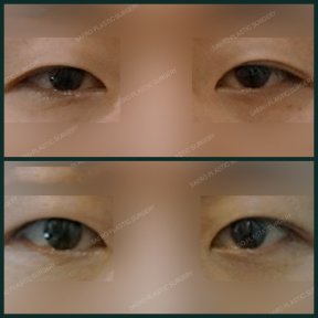 Vorher-nachher-Ergebnisse der Unterlid-Blepharoplastik bei SAERO Plastic Surgery