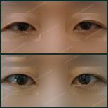 Vorher-nachher-Ergebnisse der Unterlid-Blepharoplastik bei SAERO Plastic Surgery