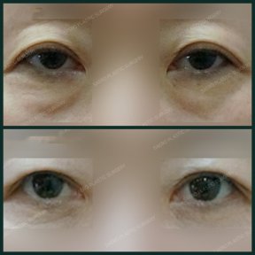 Vorher-nachher-Ergebnisse der Unterlidblepharoplastik bei SAERO Plastic Surgery, weniger Tränensäcke