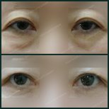 Vorher-nachher-Ergebnisse der Unterlidblepharoplastik bei SAERO Plastic Surgery, weniger Tränensäcke