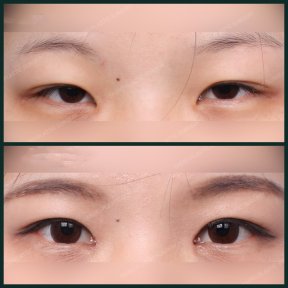 Vorher-nachher-Ergebnisse der Unterlidblepharoplastik bei SAERO Plastic Surgery, Augenverjüngung