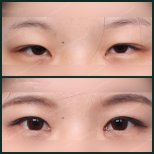 Vorher-nachher-Ergebnisse der Unterlidblepharoplastik bei SAERO Plastic Surgery, Augenverjüngung