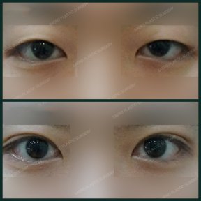 Vorher-nachher-Ergebnis der Unterlid-Blepharoplastik bei SAERO Plastic Surgery, Augenverjüngung