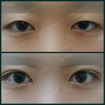 Vorher-nachher-Ergebnis der Unterlid-Blepharoplastik bei SAERO Plastic Surgery, Augenverjüngung