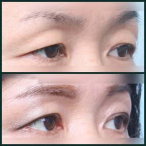Vorher-nachher-Ergebnisse der Unterlidblepharoplastik bei SAERO Plastic Surgery, Augenverjüngung