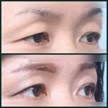 Vorher-nachher-Ergebnisse der Unterlidblepharoplastik bei SAERO Plastic Surgery, Augenverjüngung