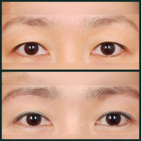 Vorher-nachher-Ergebnisse der Unterlidblepharoplastik bei SAERO Plastic Surgery, Augenverjüngung