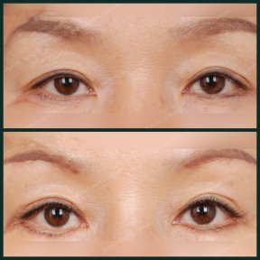 Vorher-nachher-Ergebnis der Unterlidblepharoplastik bei SAERO Plastic Surgery, Augenverjüngung