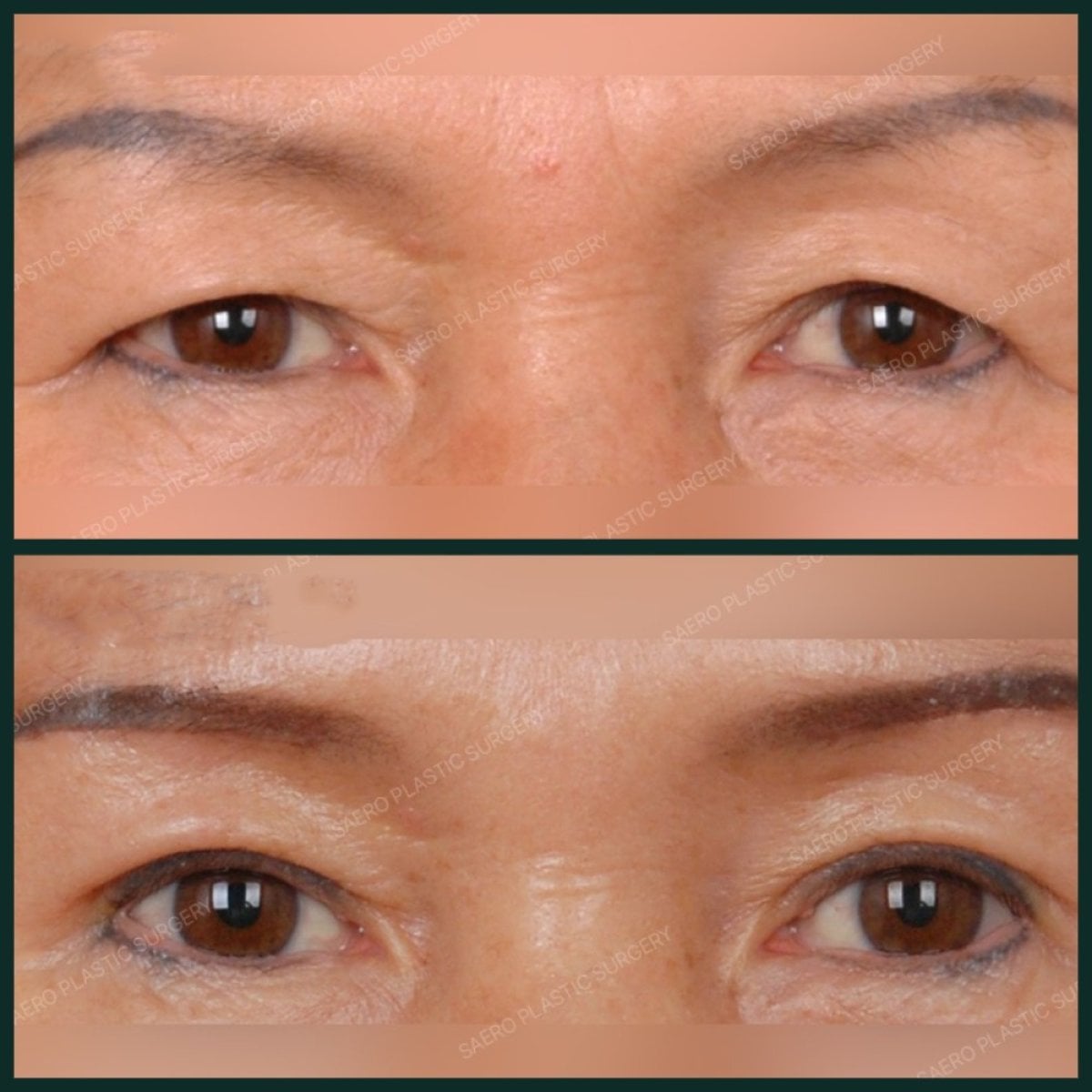 Resultados de blefaroplastia inferior antes y después en SAERO Plastic Surgery, menos bolsas