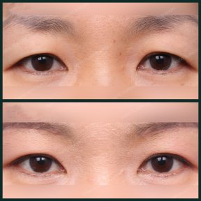 Vorher-nachher-Ergebnis der Unterlid-Blepharoplastik bei SAERO Plastic Surgery, Augenverjüngung