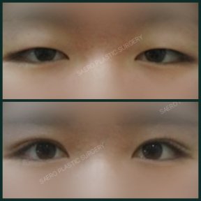 Before and after upper eyelid surgery results at SAERO Plastic Surgery, eyelid lift improvement