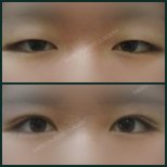 Before and after upper eyelid surgery results at SAERO Plastic Surgery, eyelid lift improvement