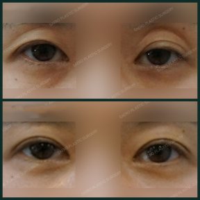Before and after upper eyelid surgery results at SAERO Plastic Surgery, improved eye contour
