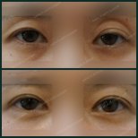 Before and after upper eyelid surgery results at SAERO Plastic Surgery, improved eye contour