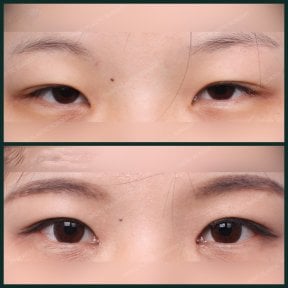 Before and after upper eyelid surgery results at SAERO Plastic Surgery, improved eye contour