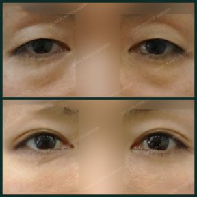 Before and after upper eyelid surgery results at SAERO Plastic Surgery, rejuvenated eye area