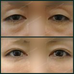 Before and after upper eyelid surgery results at SAERO Plastic Surgery, rejuvenated eye area