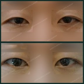 Before and after upper eyelid surgery results at SAERO Plastic Surgery, improved eye appearance