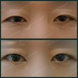 Before and after upper eyelid surgery results at SAERO Plastic Surgery, improved eye appearance