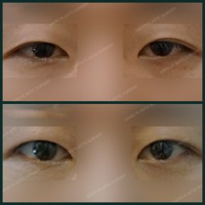 Before and after upper eyelid surgery results at SAERO Plastic Surgery, improved eye appearance