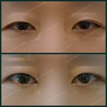 Before and after upper eyelid surgery results at SAERO Plastic Surgery, improved eye appearance