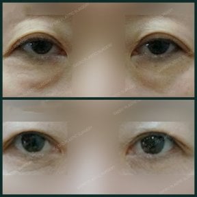 Before and after upper eyelid surgery results at SAERO Plastic Surgery, rejuvenated eye area