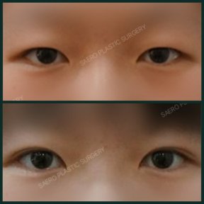 Before and after upper eyelid surgery results at SAERO Plastic Surgery, improved eye contour