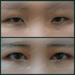Before and after upper eyelid surgery results at SAERO Plastic Surgery, improved eye appearance