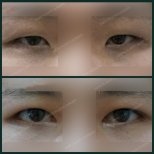 Before and after upper eyelid surgery results at SAERO Plastic Surgery, improved eye appearance