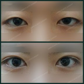 Before and after upper eyelid surgery results at SAERO Plastic Surgery, improved eye appearance