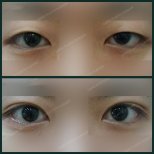 Before and after upper eyelid surgery results at SAERO Plastic Surgery, improved eye appearance
