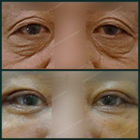 Before and after upper eyelid surgery results at SAERO Plastic Surgery, reduced eyelid sagging