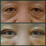 Before and after upper eyelid surgery results at SAERO Plastic Surgery, reduced eyelid sagging