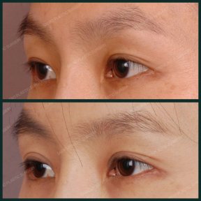 Before and after upper eyelid surgery results at SAERO Plastic Surgery, improved eye contour