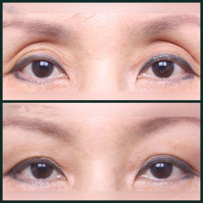 Upper eyelid surgery before and after results at SAERO Plastic Surgery, rejuvenated eye area
