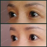 Before and after upper eyelid surgery results at SAERO Plastic Surgery, improved eyelid contour