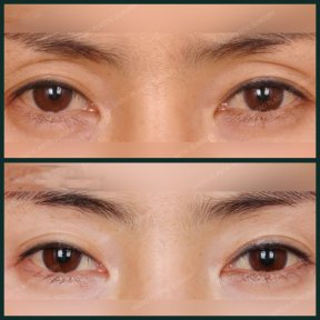 Before and after upper eyelid surgery results at SAERO Plastic Surgery, eyelid lift improvement