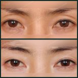 Before and after upper eyelid surgery results at SAERO Plastic Surgery, eyelid lift improvement